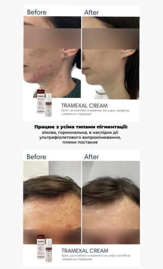 Освітлюючий крем проти пігментації Braderm TRAMEXAL, 30 мл